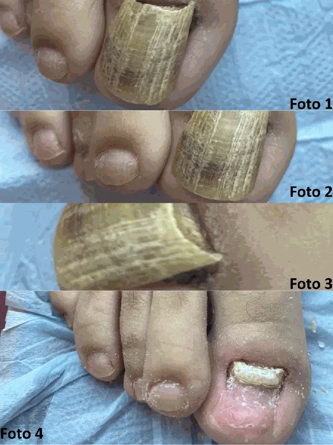 Registro de tratamento de micose de unha