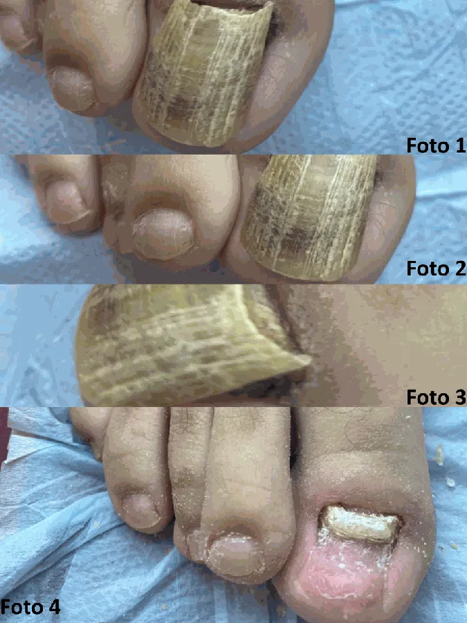 Quatro fotos mostrando a evolução de uma unha com fungo durante o tratamento com laserterapia