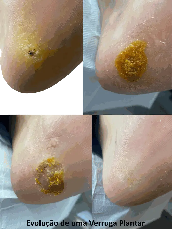 Registro de tratamento de verruga plantar